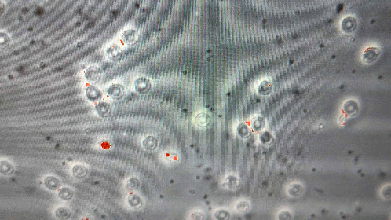 How Platelet Aggregates Reduce Apparent Platelet Counts in PRP