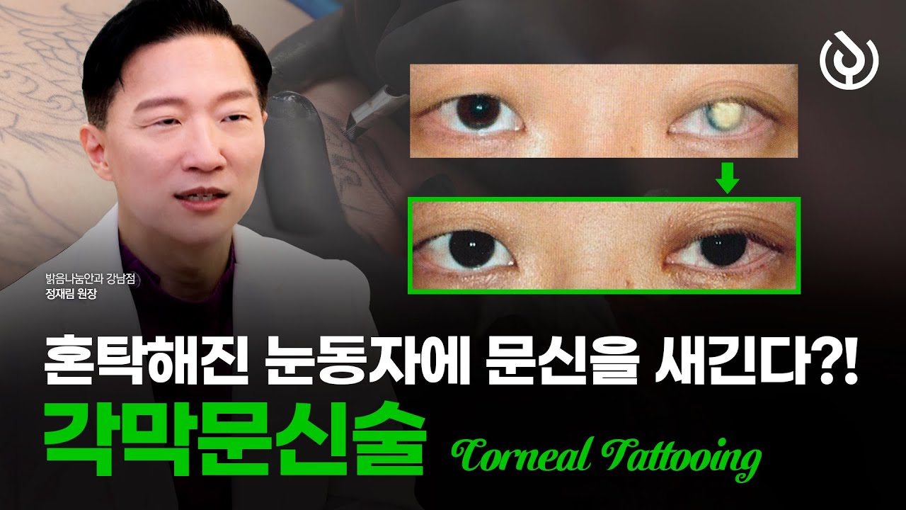혼탁해진 눈동자에도 문신이 가능할까? '각막문신술' | 밝음나눔안과