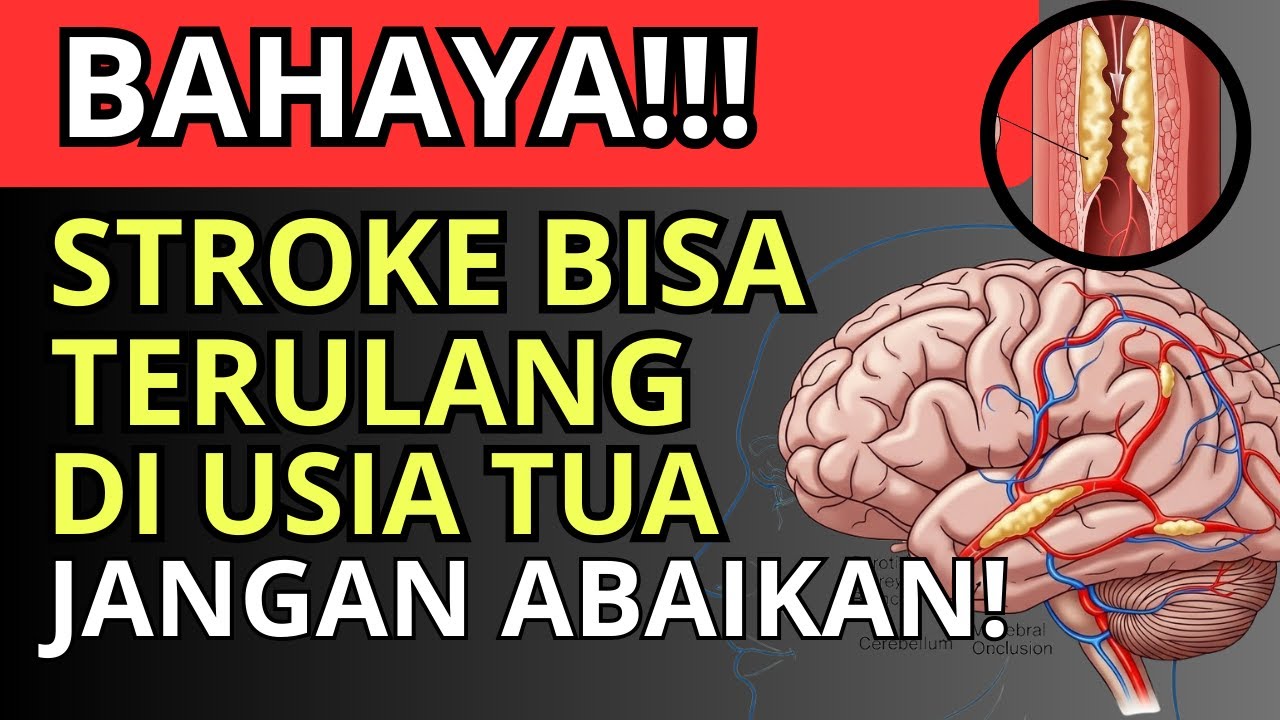 BAHAYA‼️STROKE Kedua Bisa Terjadi Diam-Diam, Lakukan ini Sebelum TERLAMBAT!