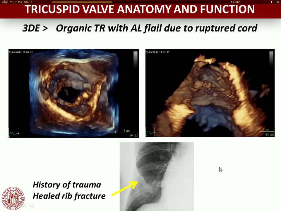 Tricuspid valve