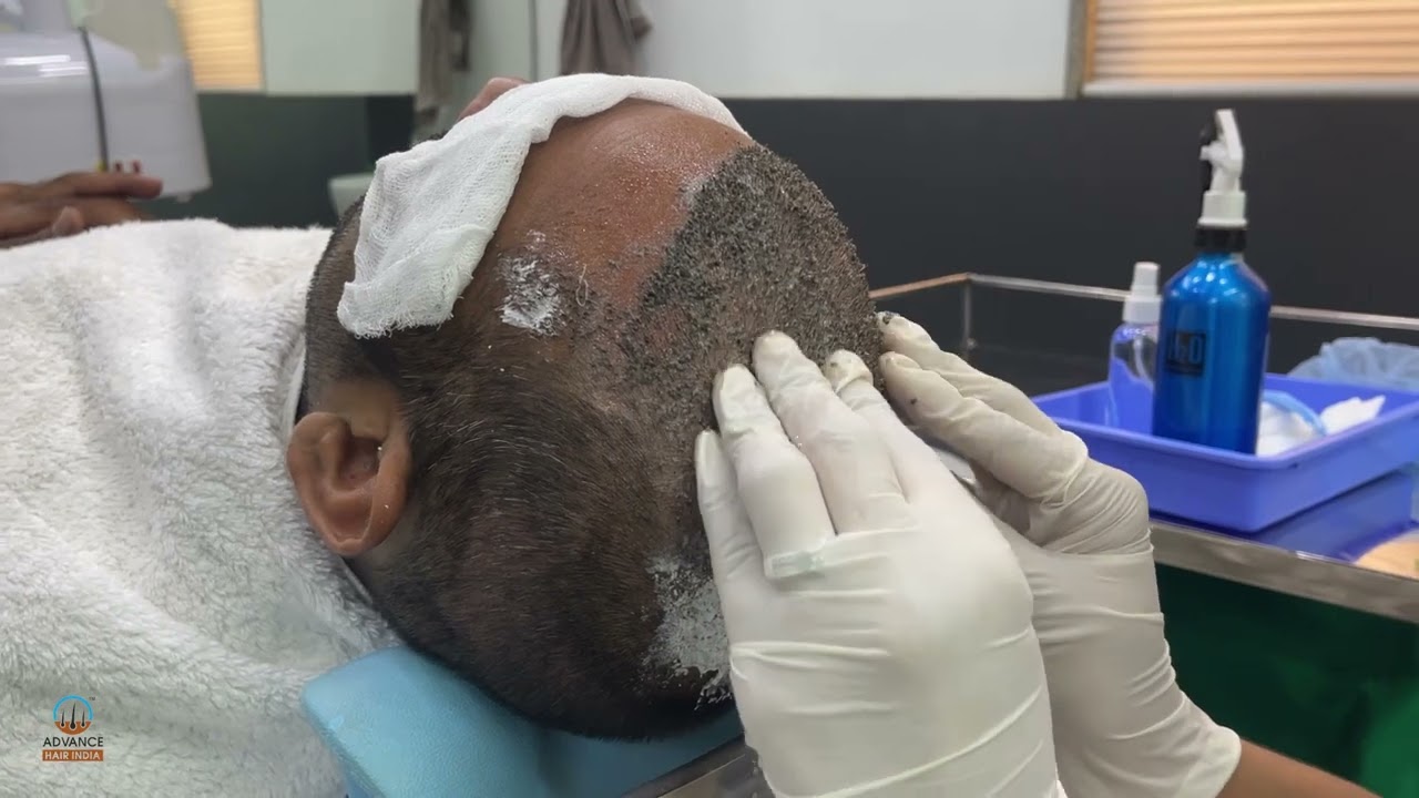 How To Wash Your Hair After Hair Transplant | How to wash your Hair | Advance Hair India