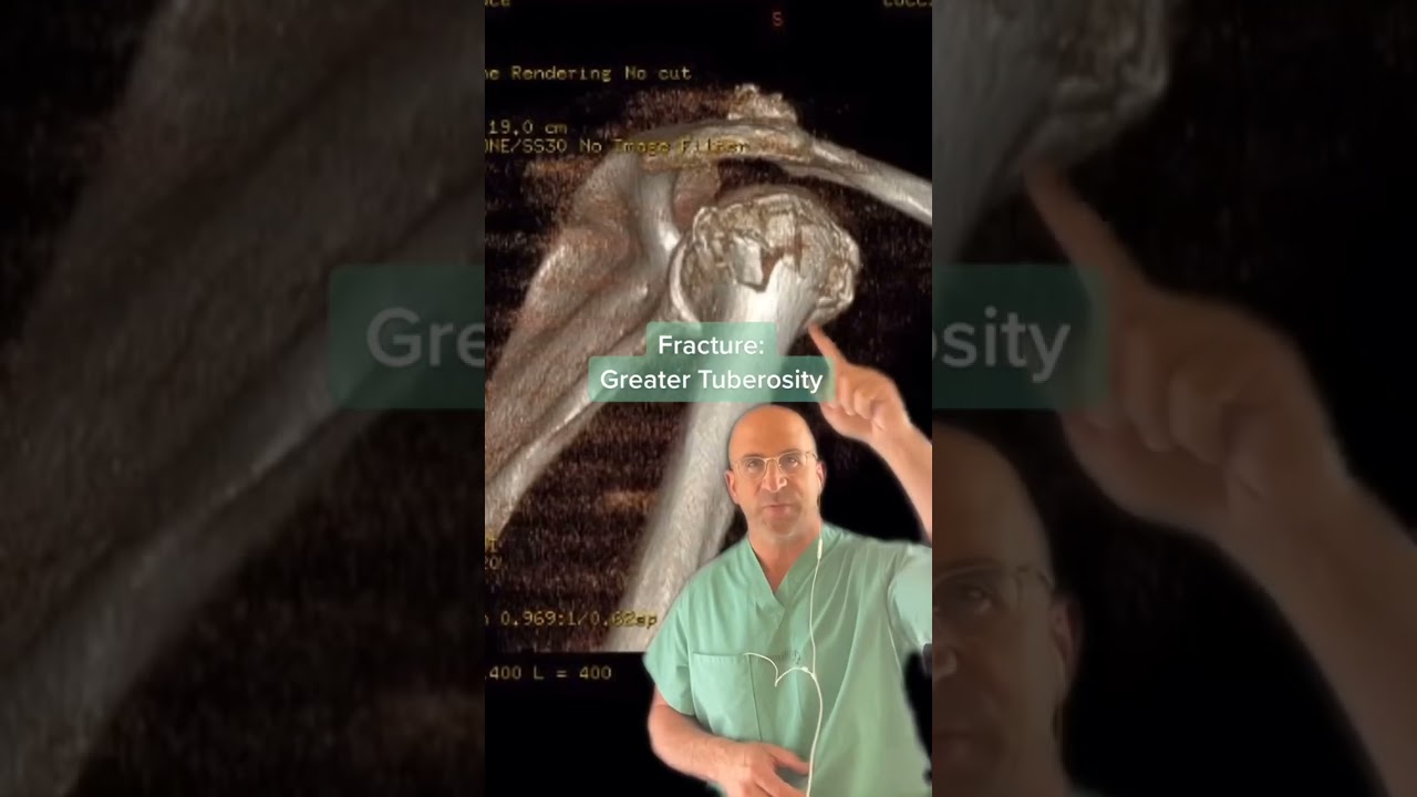 3D Shoulder Fracture #orthopedics #bonefracture #medtech #CTscan #radiology