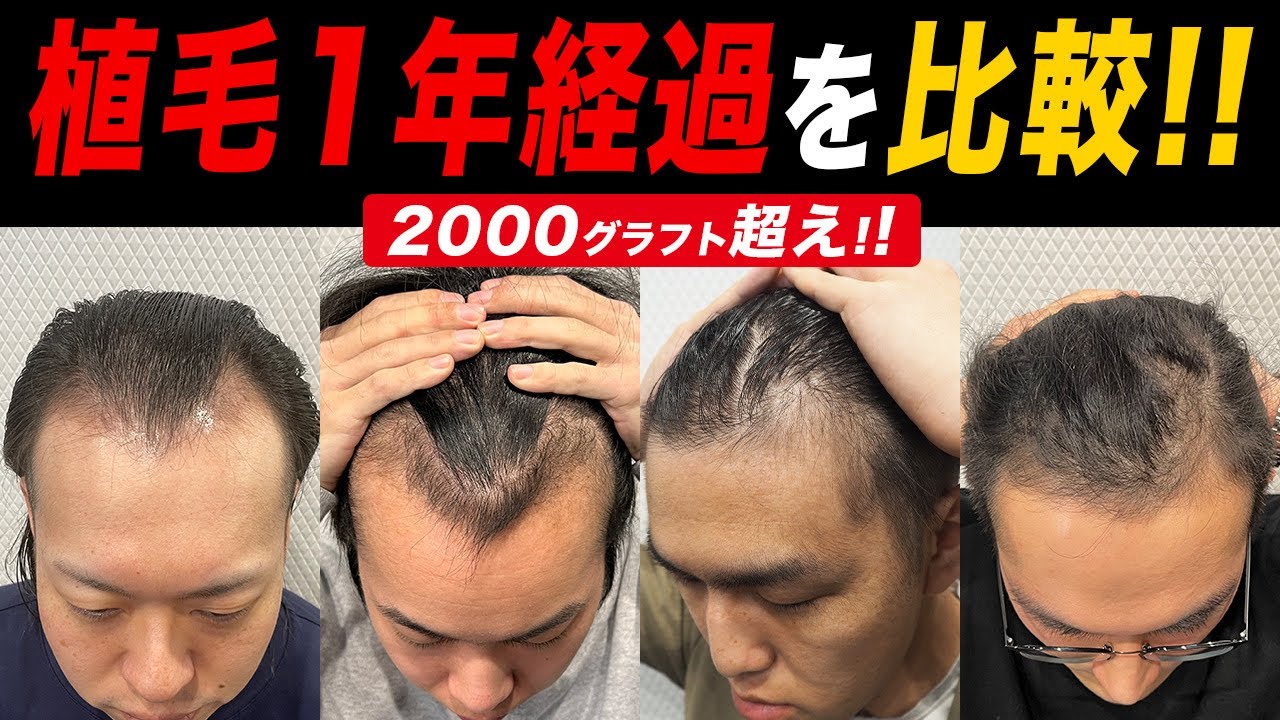【自毛植毛】1年経過したモニターさんの経過を比較したら衝撃の結末だった...