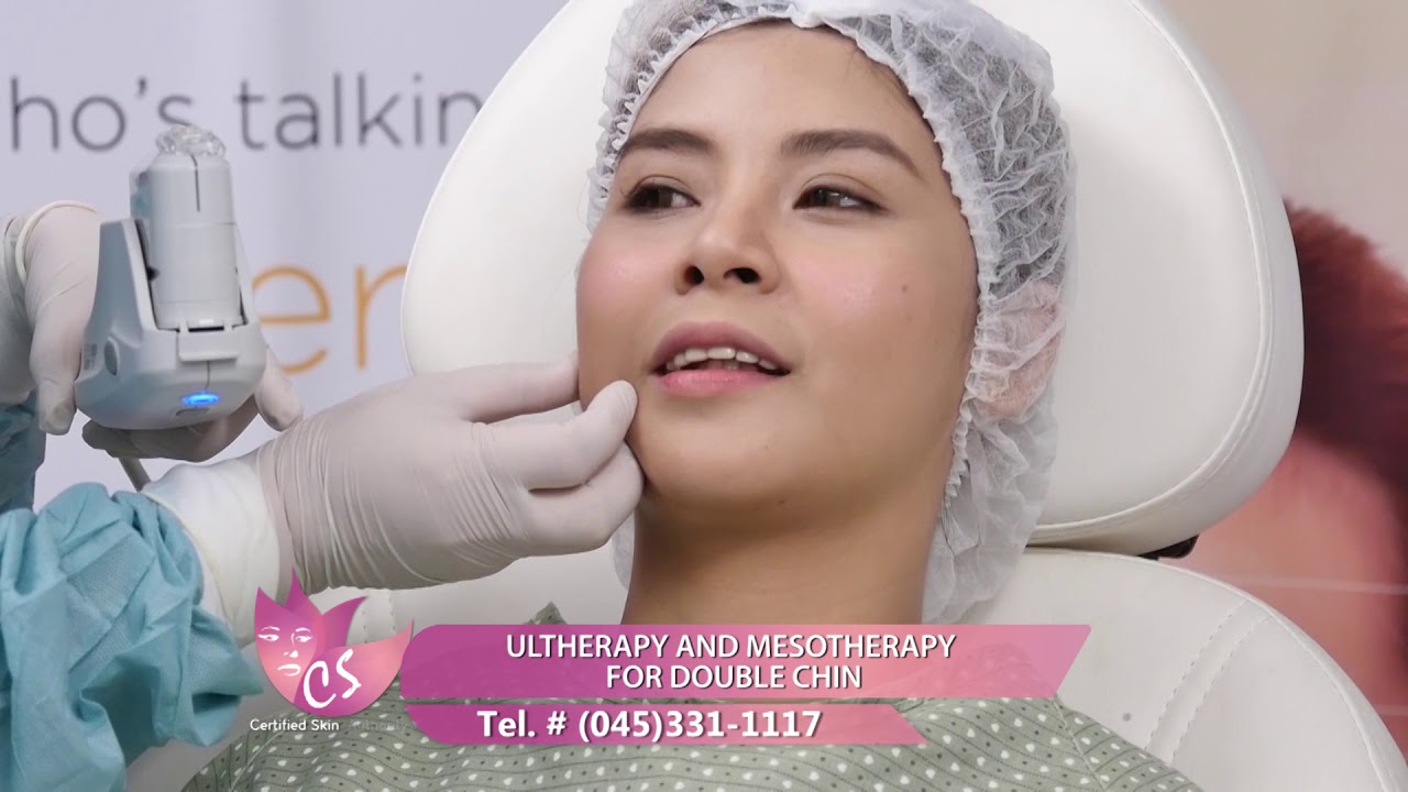 ULTHERAPHY AND MESOTHERAPY FOR DOUBLE CHIN