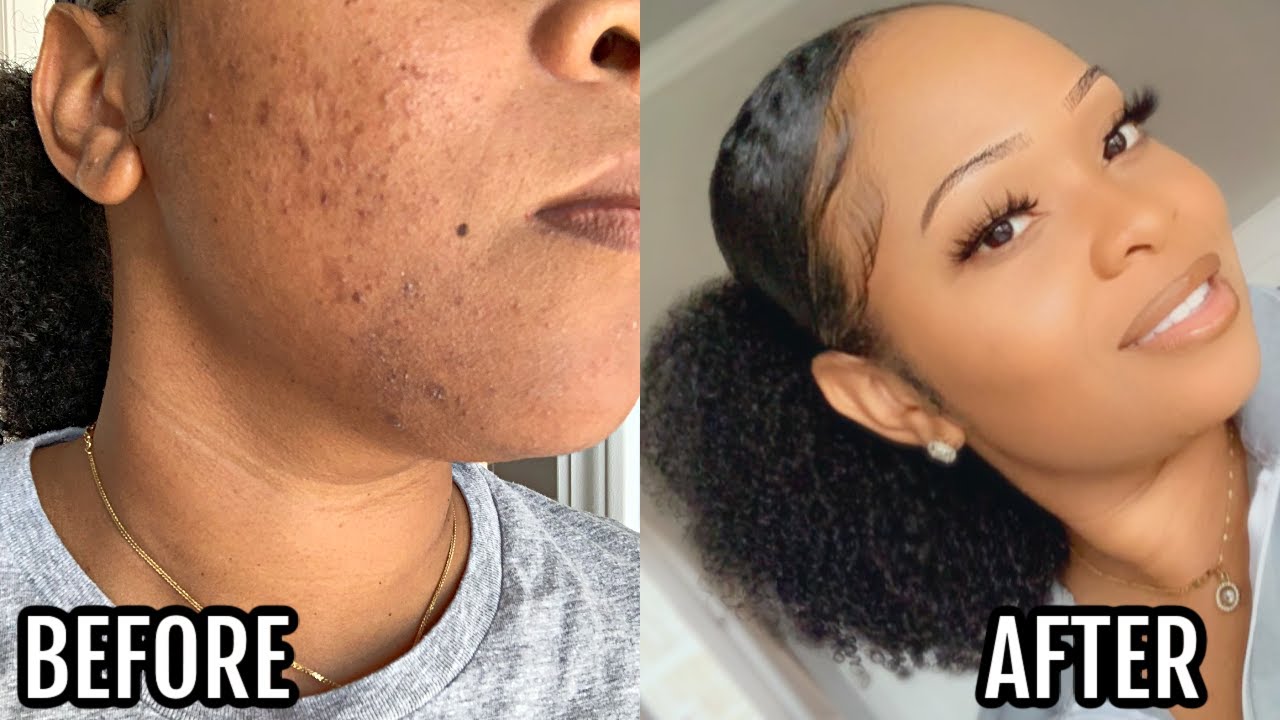 I Got Clear Skin Doing This For One Week + Video Proof | Acne & Scars Skin Care Routine | Glass Skin
