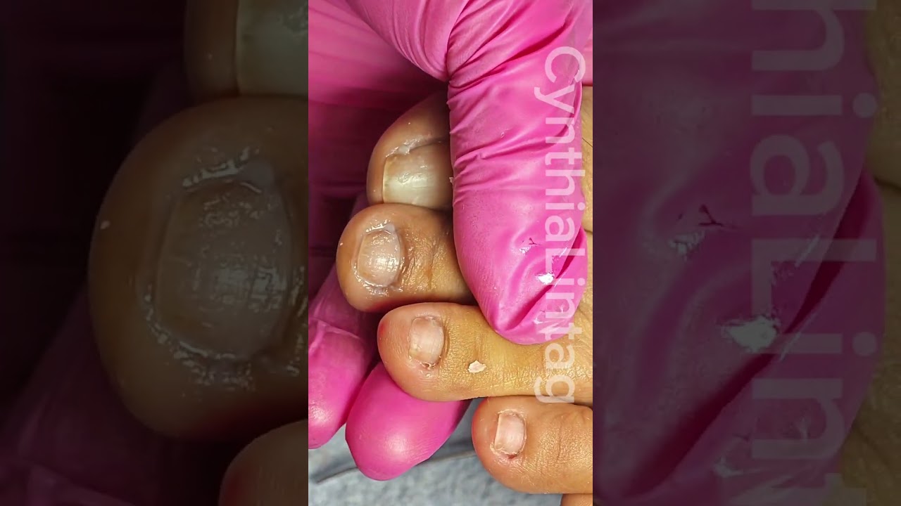 Full video pedicure with ingrown removal 