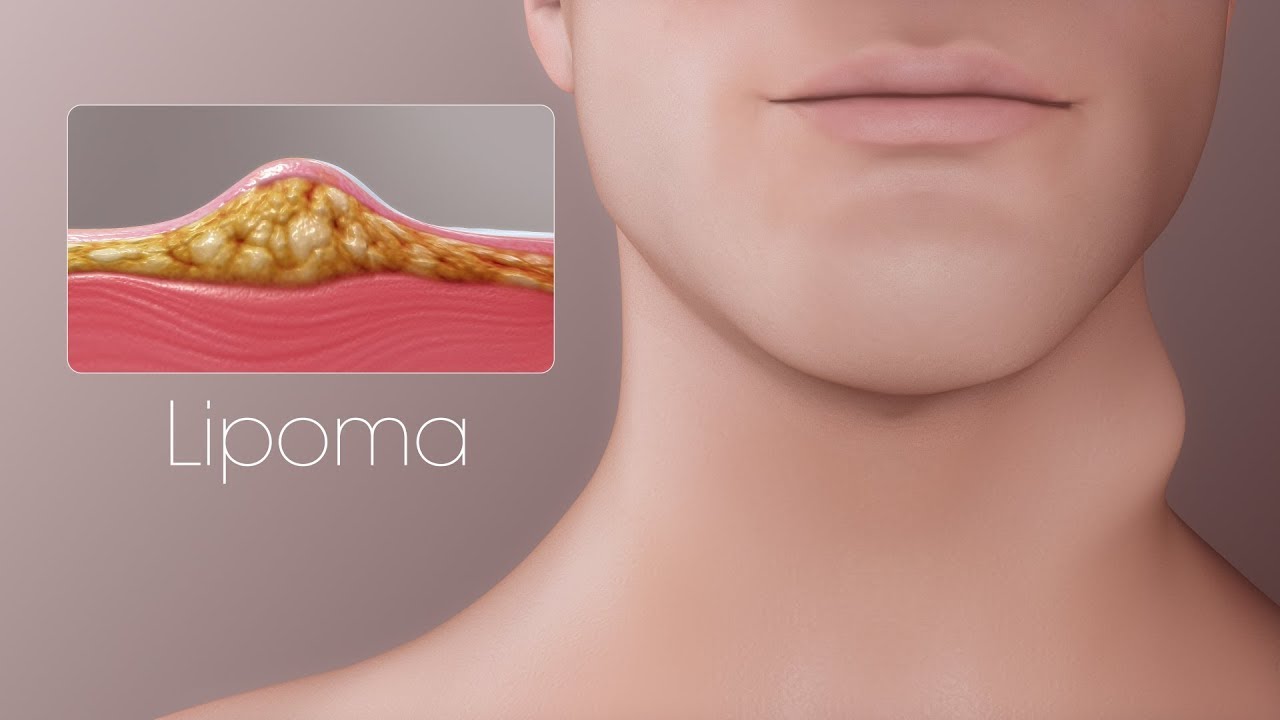 Comment guérir un lipome de façon naturelle || Santé Nutrition Beauté