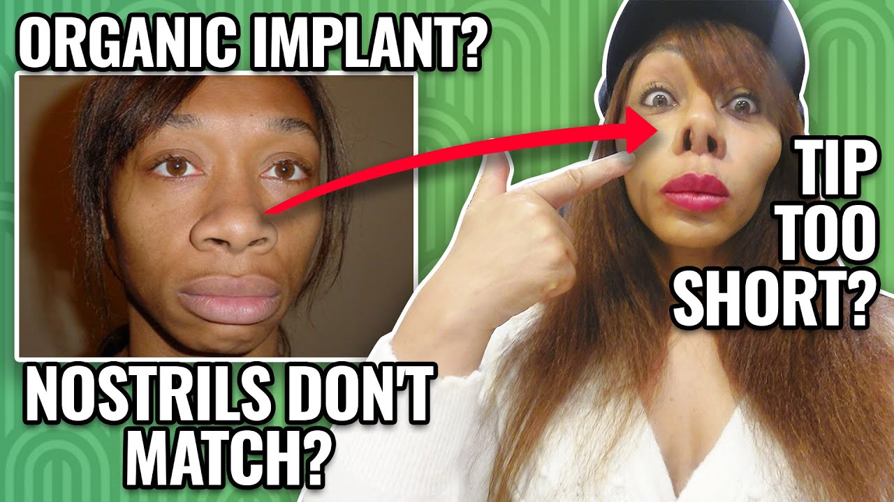 What I wish I knew before my nose job | Opt into Beauty