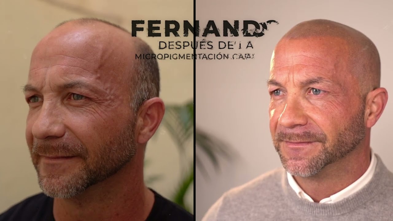 Fernando recuperó su línea frontal gracias a la micropigmentacion capilar-ALDEMAR CAMPOS