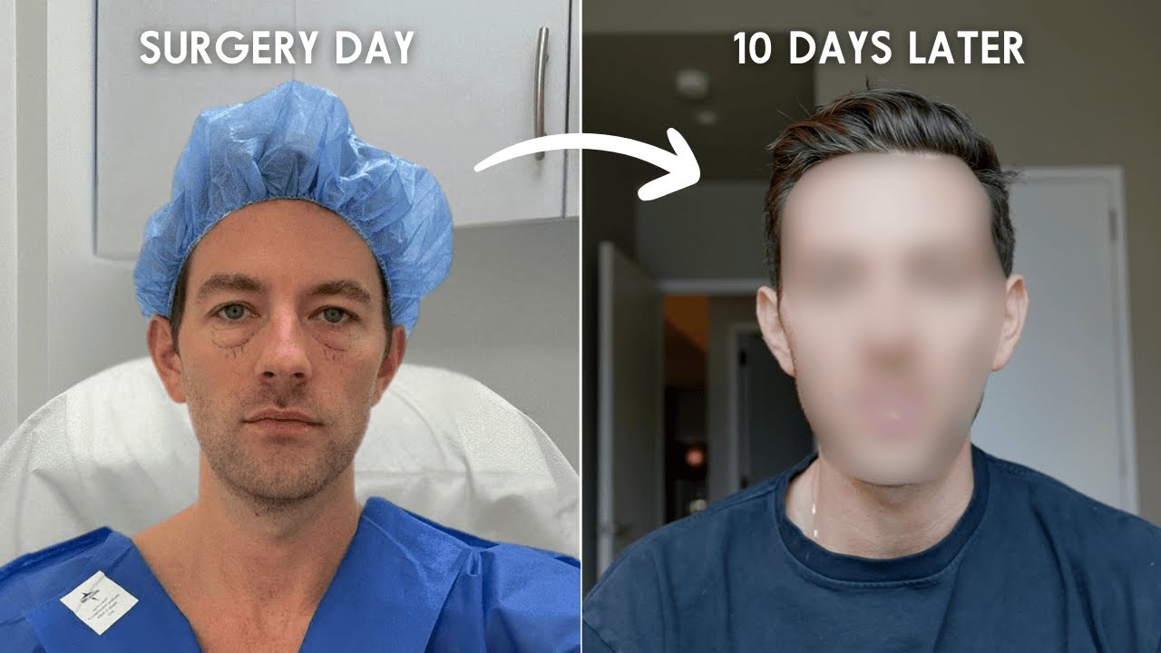 I had my eye bags removed (lower blepharoplasty)