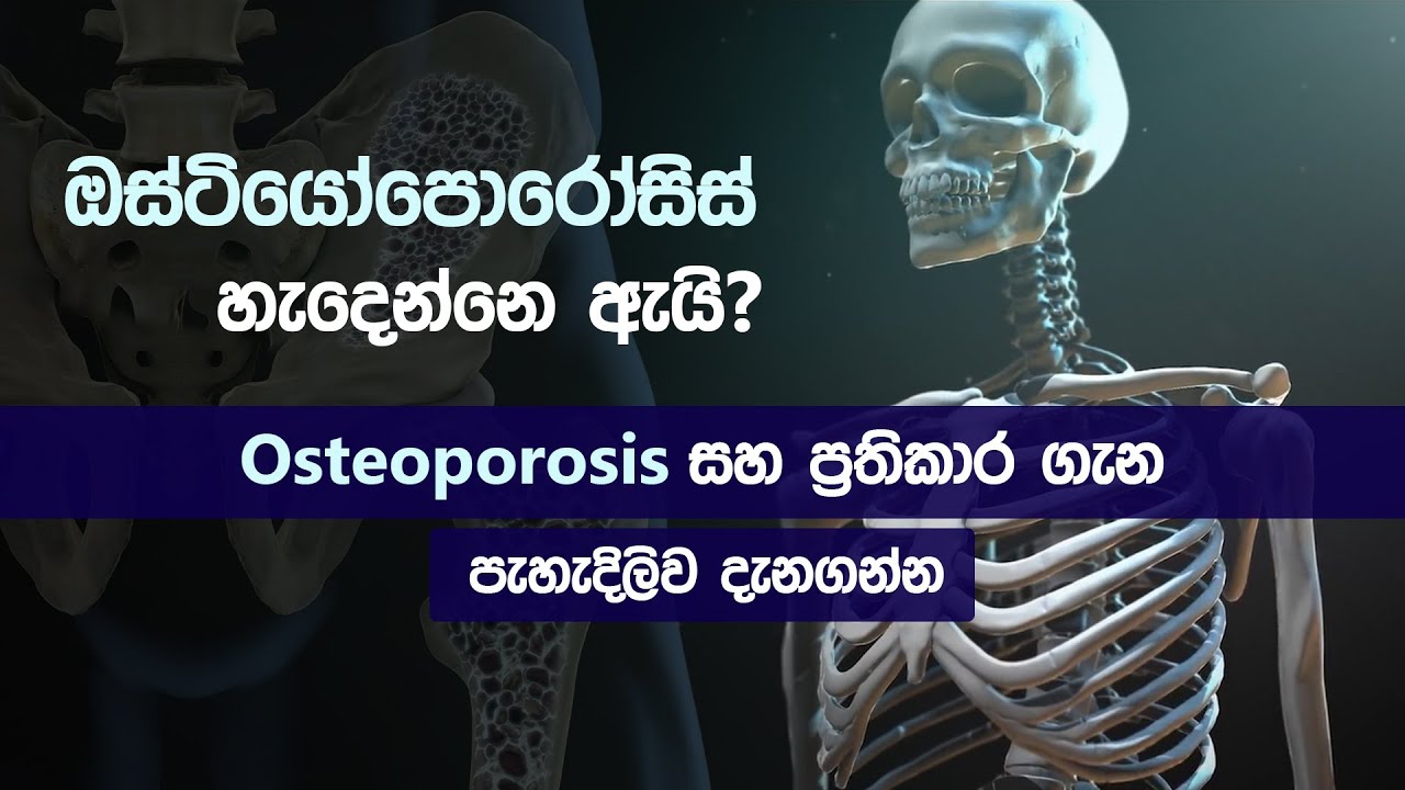 ඔස්ටියෝපොරෝසිස් ගැන දැනගමු 😨| Osteoporosis | symptoms | causes | treatment in sinhala
