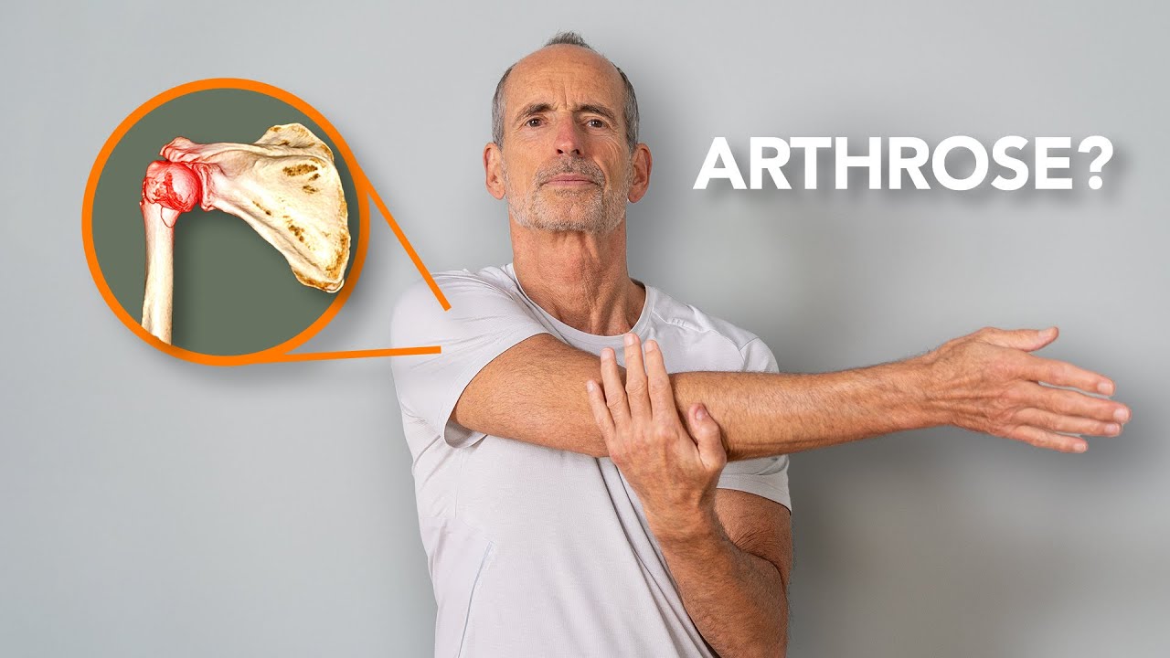 Schulterarthrose - Das muss jeder Betroffene wissen!
