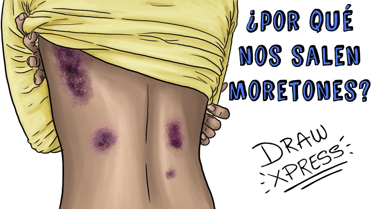 ¿POR QUÉ NOS SALEN MORETONES? | Draw My Life