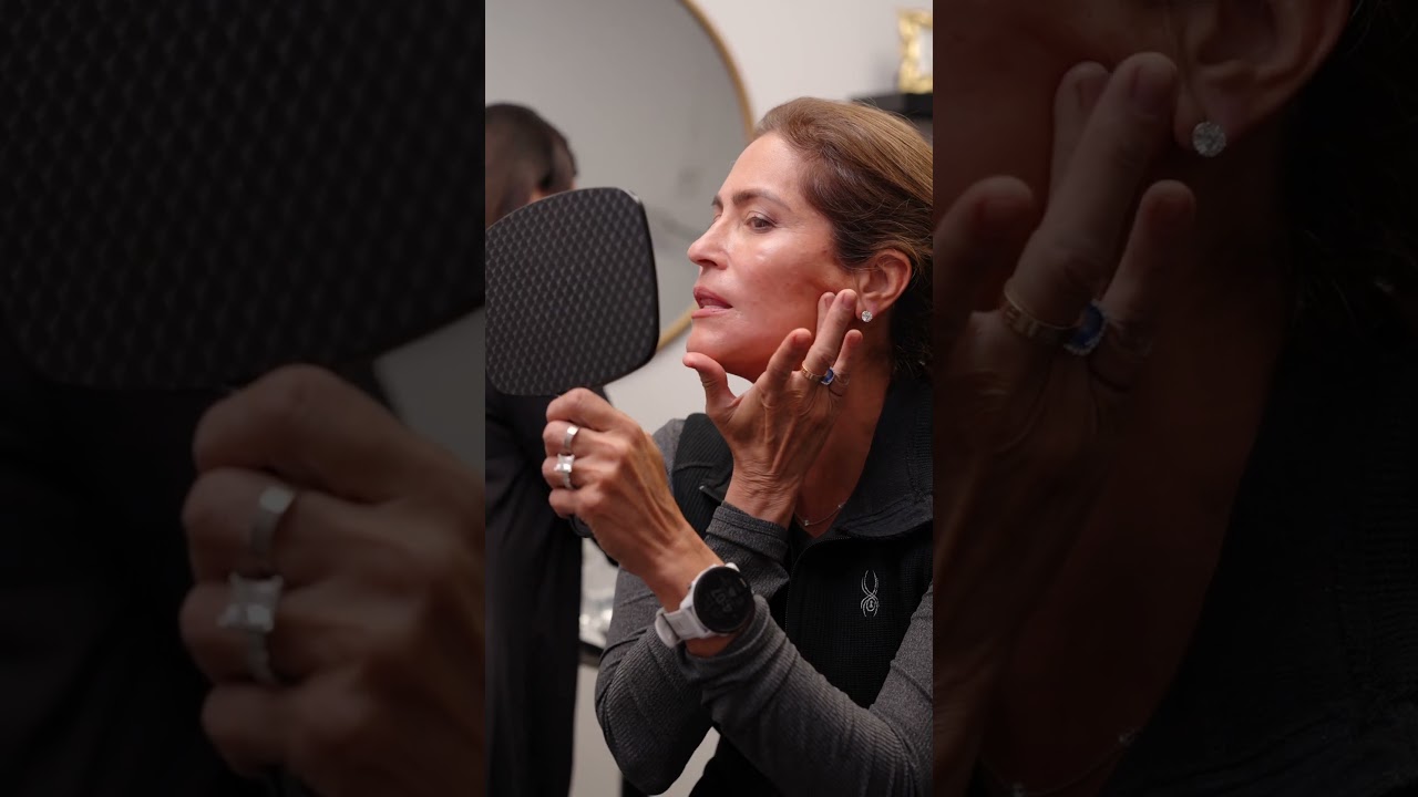 Achieve a Subtle Lift with Hyperdilute Radiesse #filler