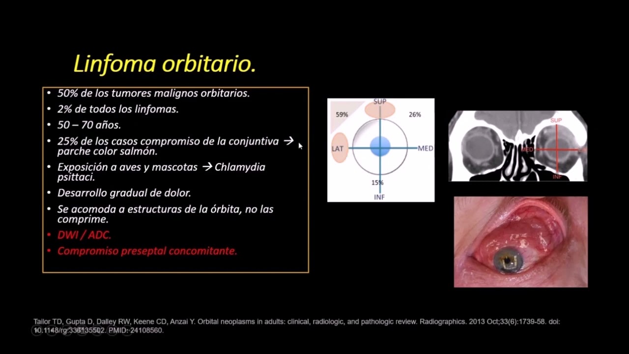 Radiología en 5 minutos: Linfoma orbitario.