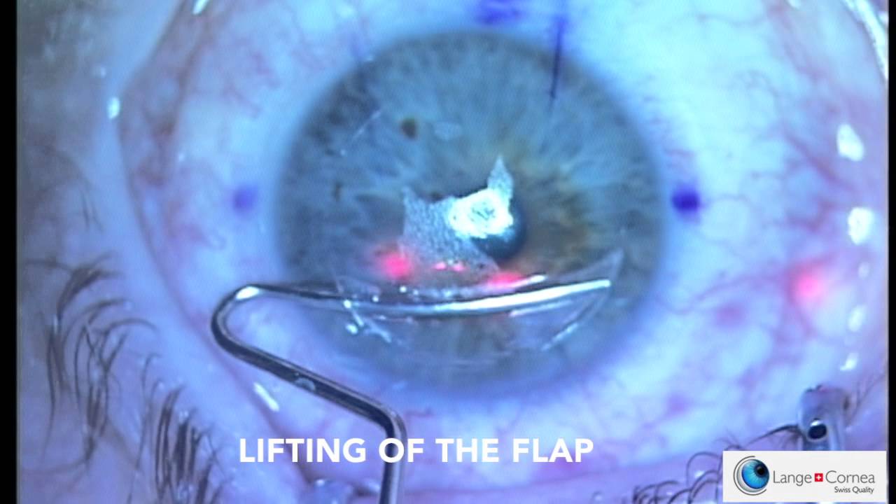 Femto Lasik by Dr. Alex Lange