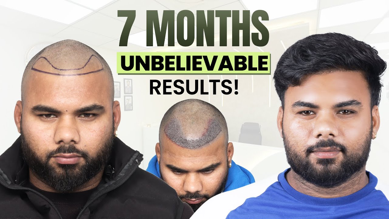 Hair Transplant in Agra  | Best Results & Cost of Hair Transplant in Agra