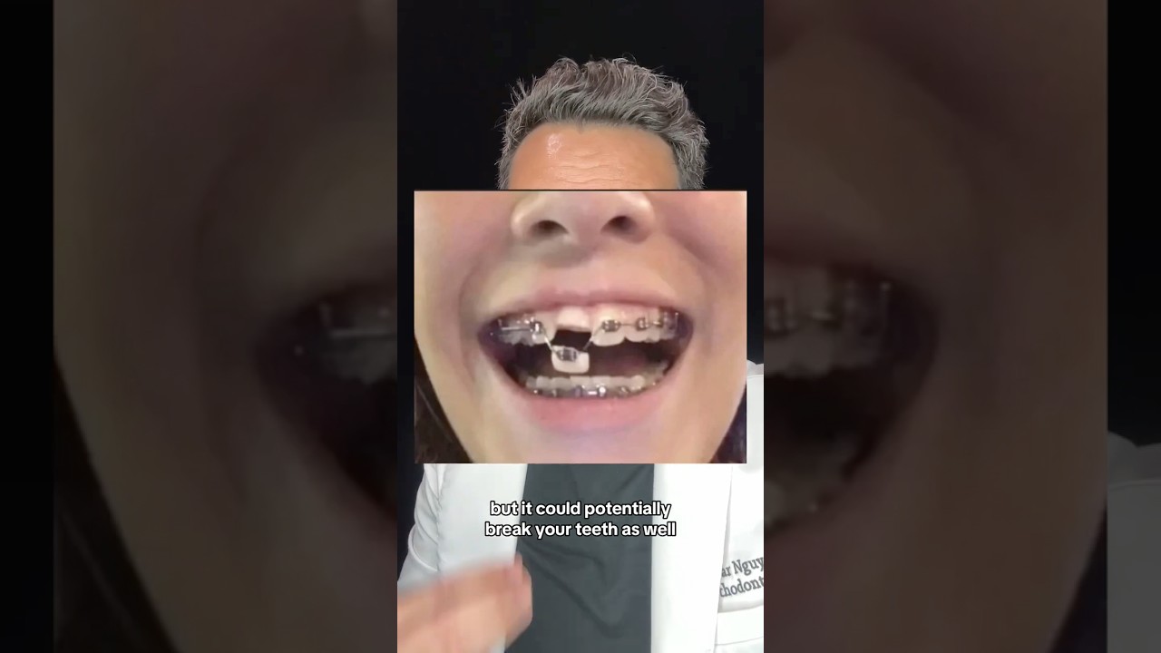 Things NOT to do when you first get Braces