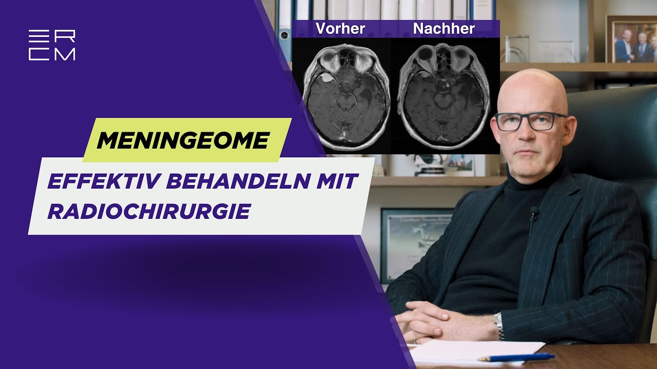 Meningeome effektiv behandeln: Radiochirurgie als Behandlungsalternative ohne OP