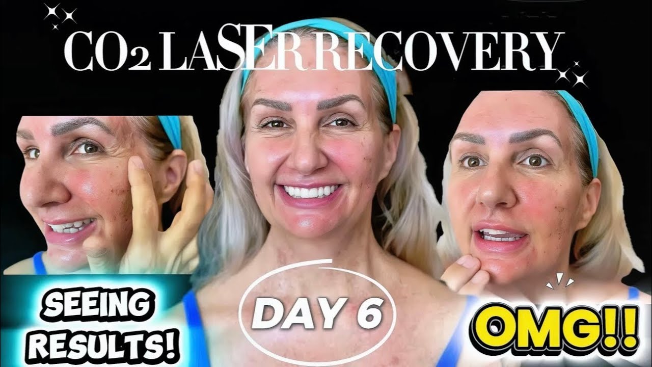 😆 CO2 Ablative Laser Resurfacing Treatment In Mexico - DAY 6 SEEING RESULTS!  