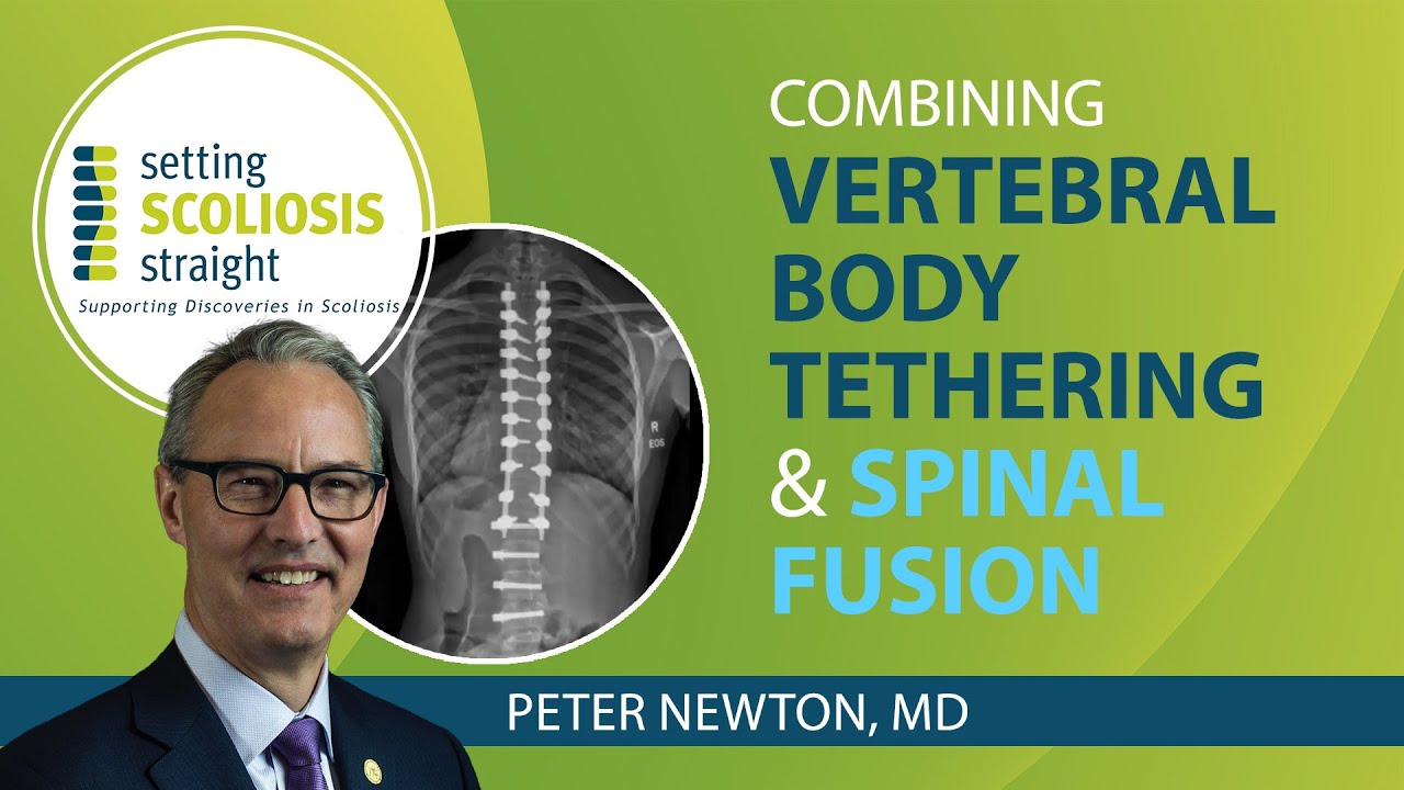 Combining Spinal Fusion and Vertebral Body Tethering