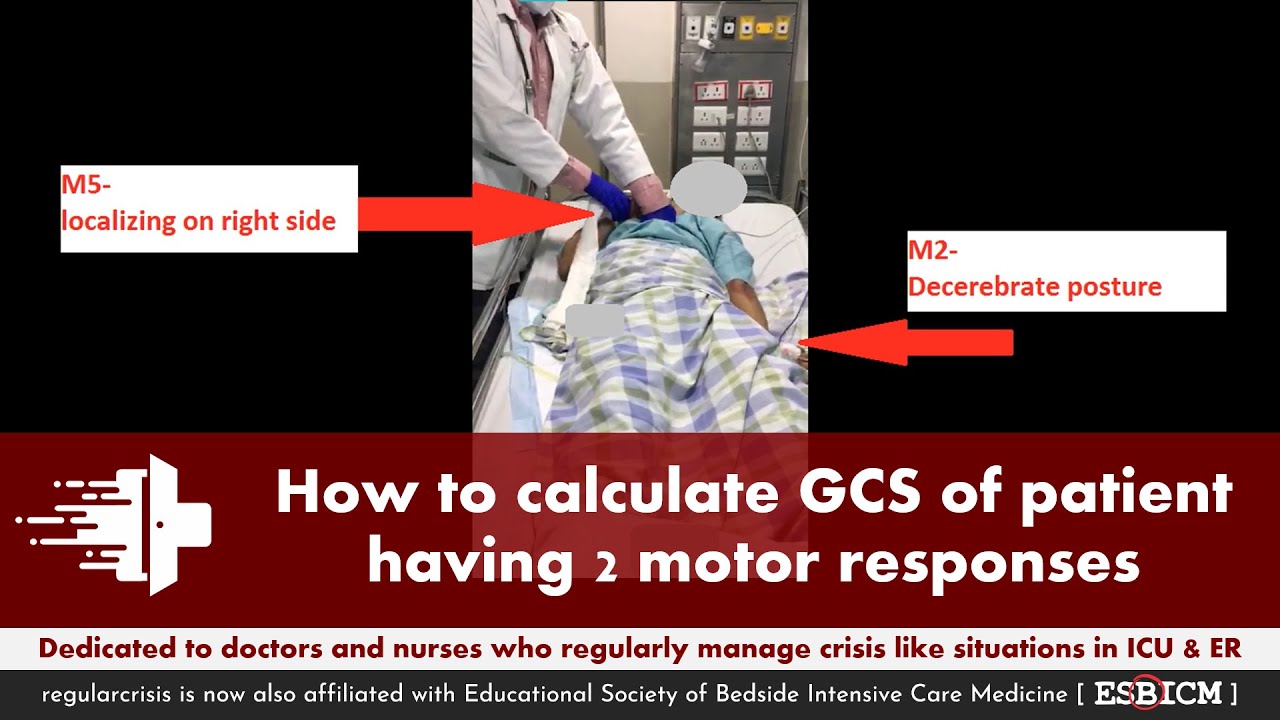 How to calculate GCS of the patient having 2 different motor response on two sides | regularcrisis
