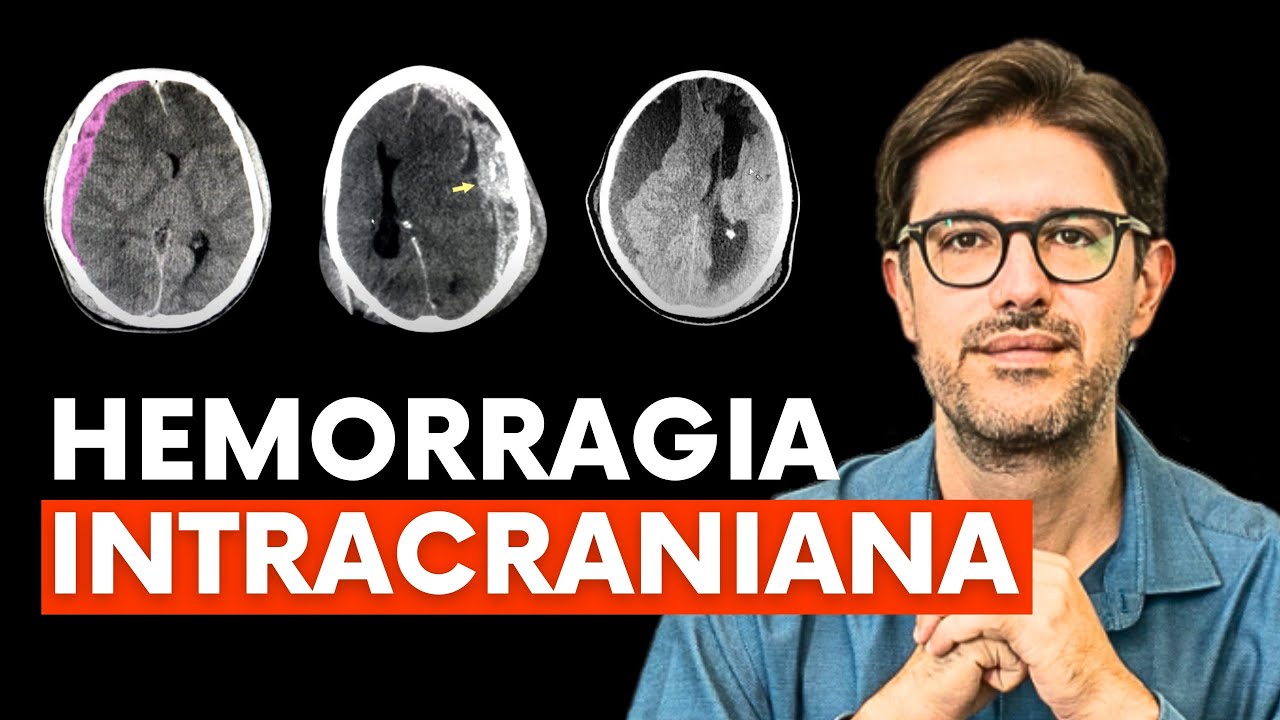 Hemorragia Intracraniana - Entenda o Que é o Hematoma Subdural