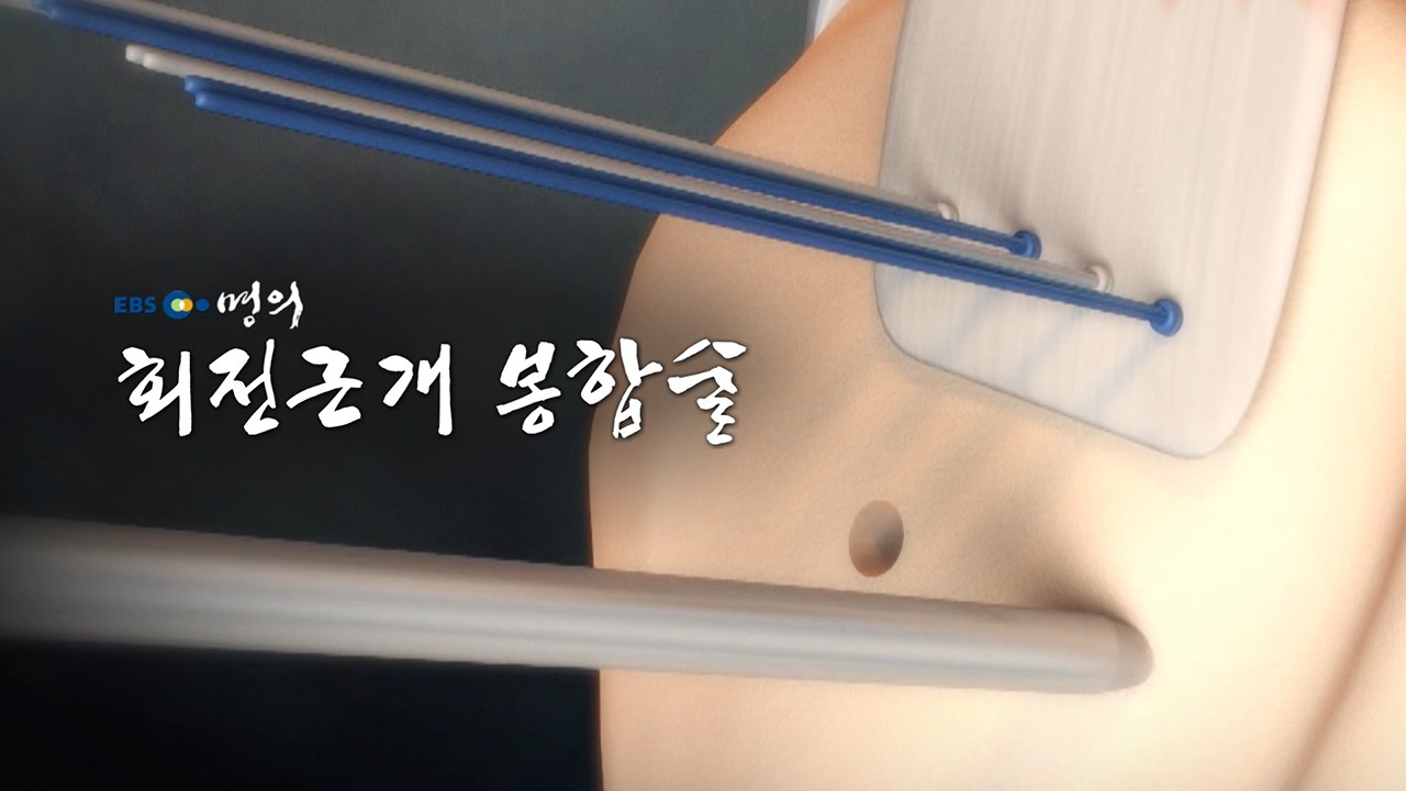 [명의 의학백과📖]회전근개 봉합술
