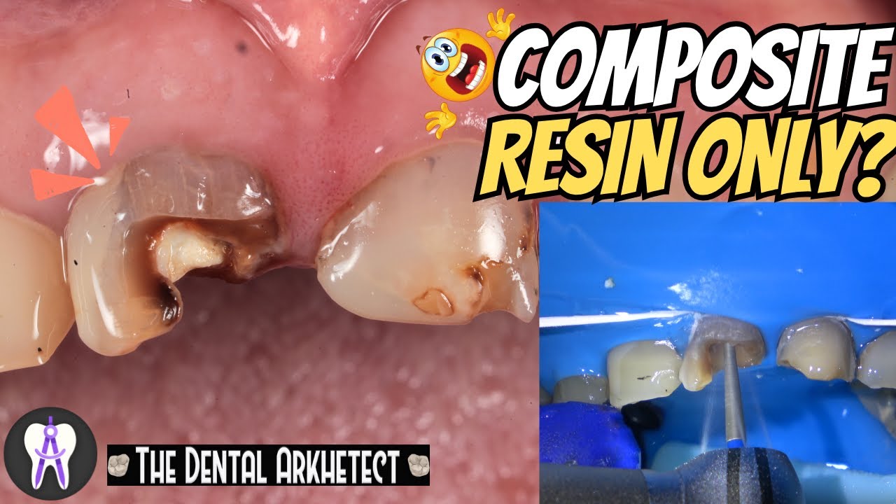 SIMPLE RESTORATION OF A ROOT CANAL TREATED TEETH #4k #dentist #C82