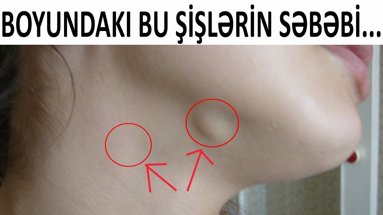 Limfa düyünləri niyə şişir? - BAXIN