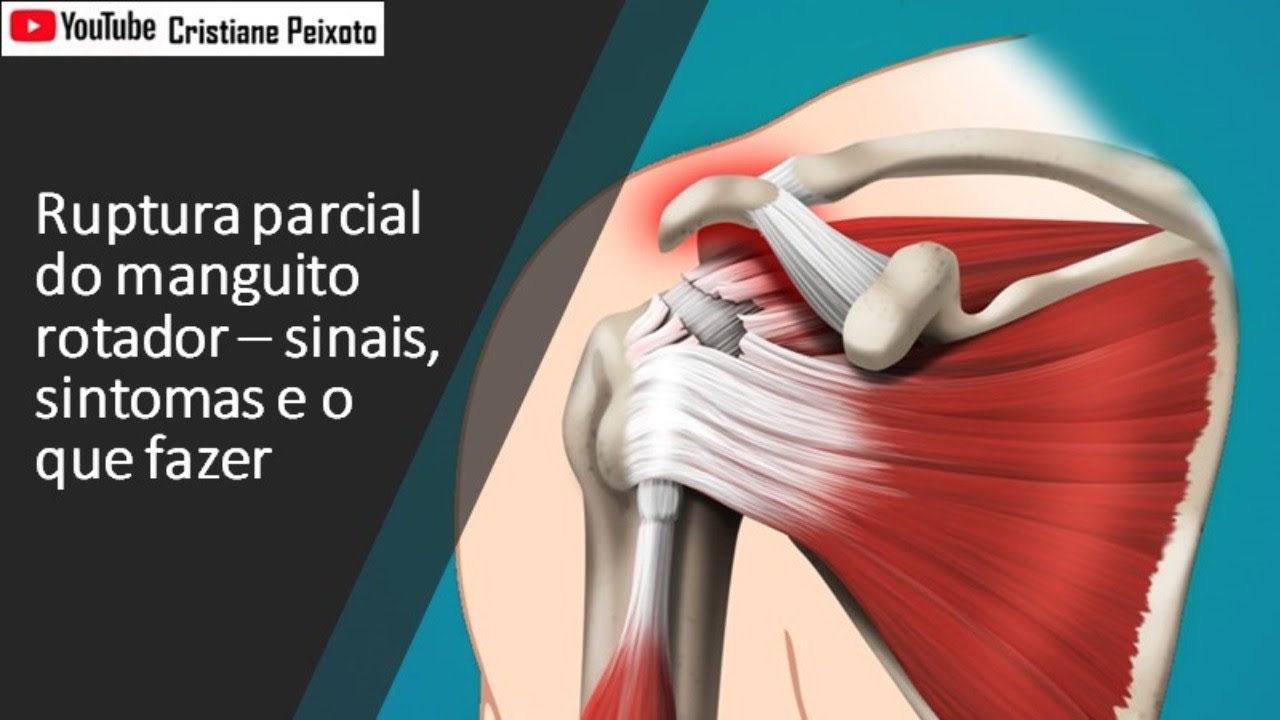 Ruptura parcial do manguito rotador -  sinais, sintomas e o que fazer.