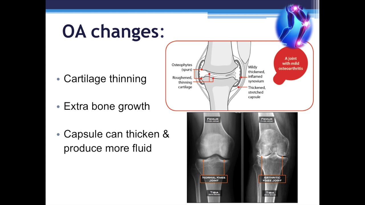 Physiotherapy education: Osteoarthritis lower limb part - part 1