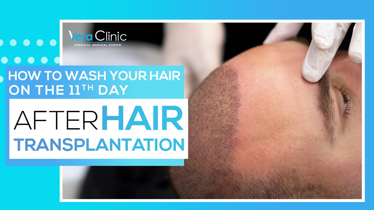 How to wash your hair on the 11th day after hair transplant operation?