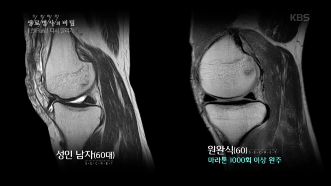 생로병사의 비밀 - 마라톤 풀코스를 1,000번 이상 달린 사람의 무릎 상태는? 20180523