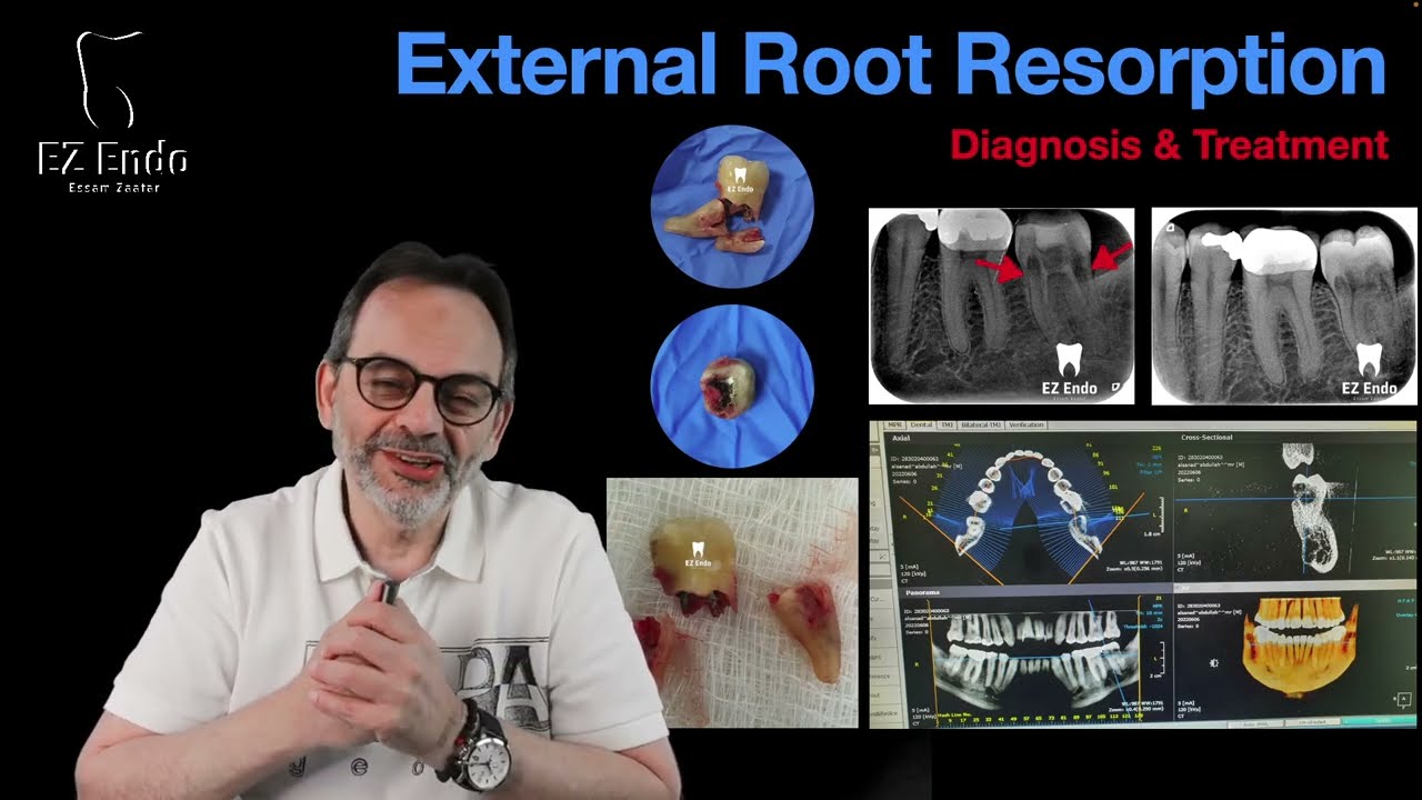 External Root Resorption (Etiology-Types-Treatment) الامتصاص الخارجي لجذور الاسنان - الاسباب والعلاج