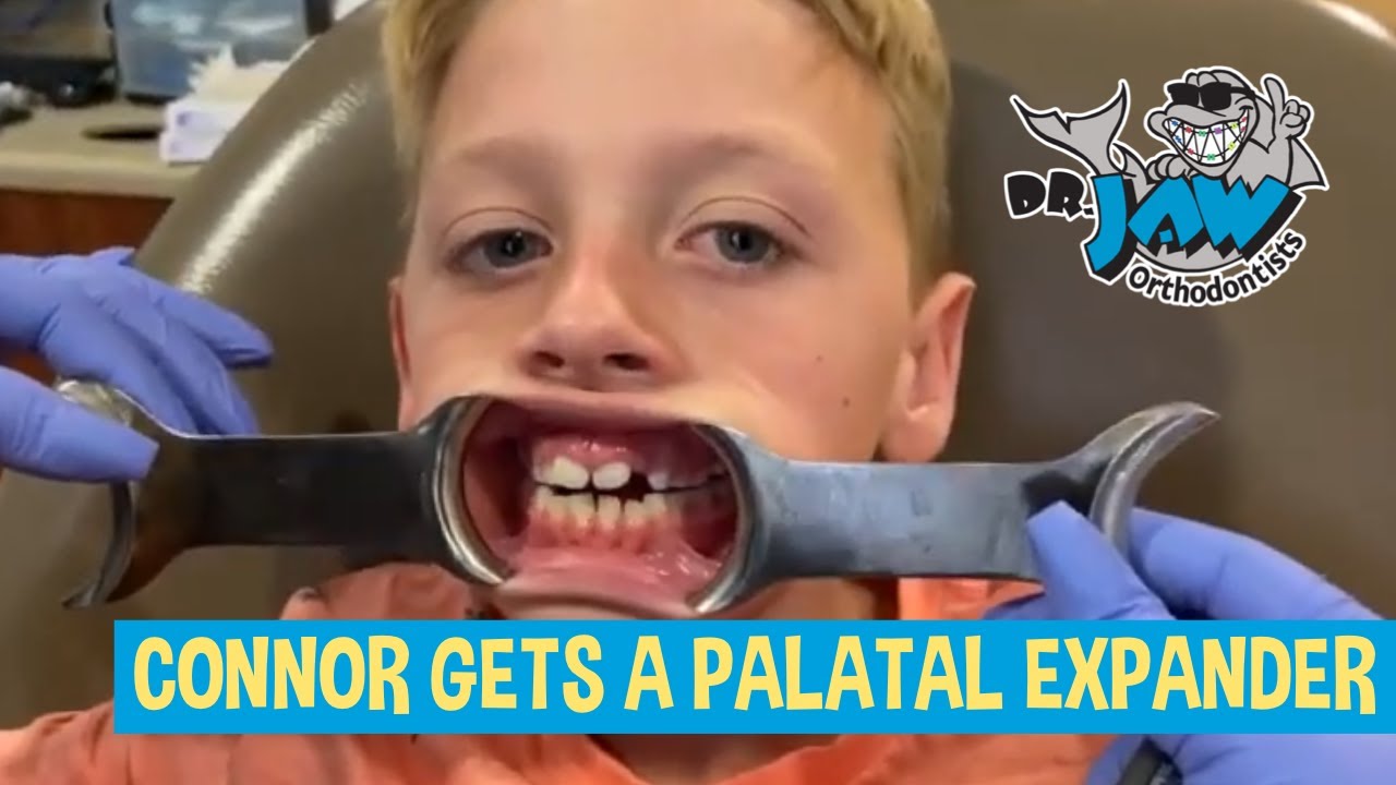 Connor Gets a Palatal Expander at Dr. JAW Orthodontists