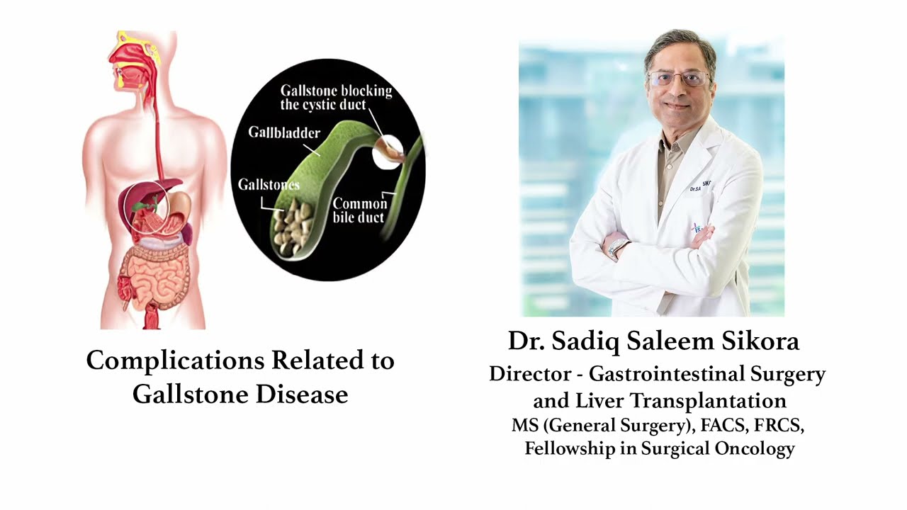 Dr. Sadiq Saleem Sikora on Gallstone Diseases| Sakra World Hospital