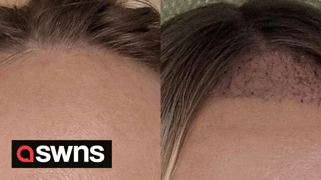 Woman has hair transplant to cover 