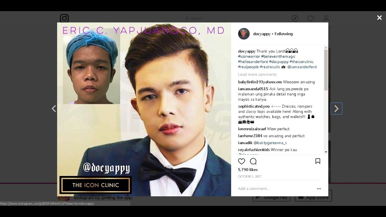 Rhinoplasty | NoseLift | NoseJob Philippines