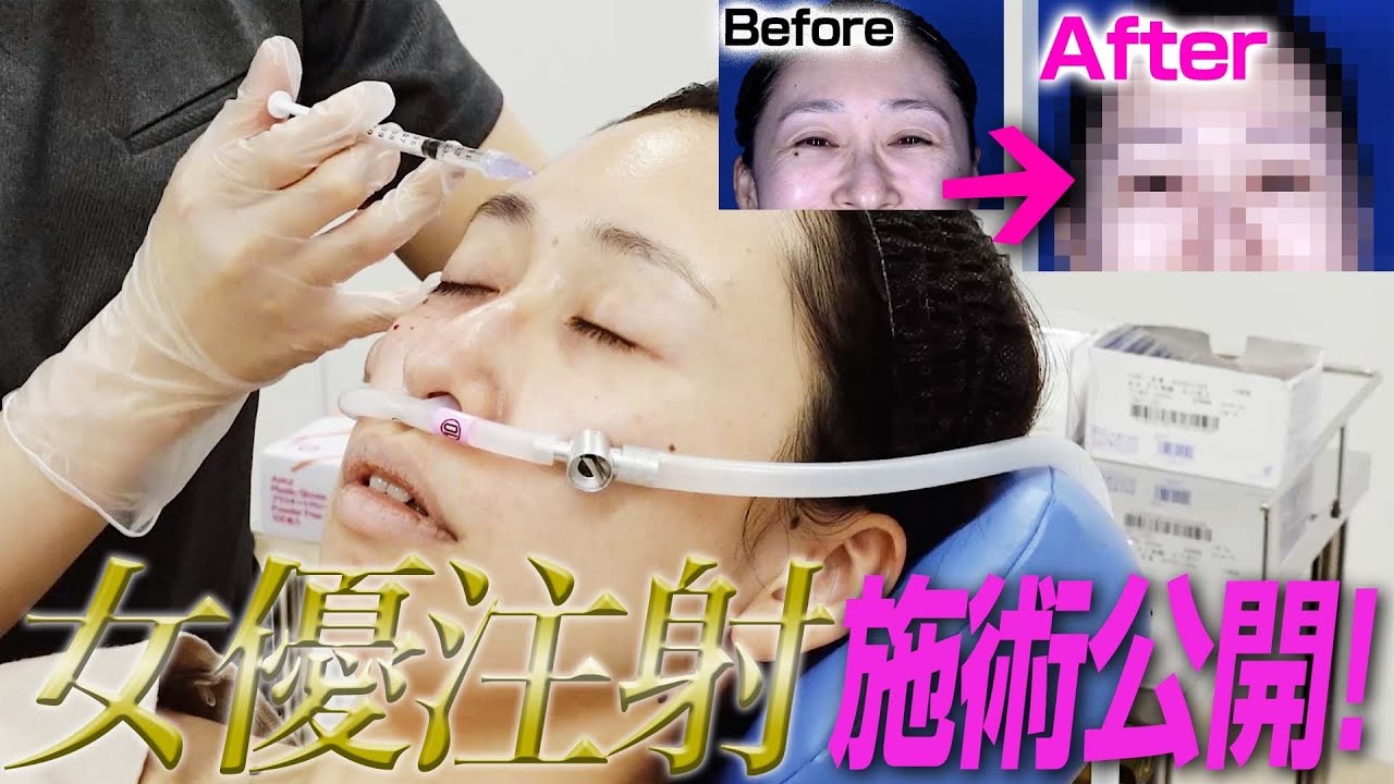 【透明感アップ】女優注射を３回受けたスタッフさんに登場してもらいました。