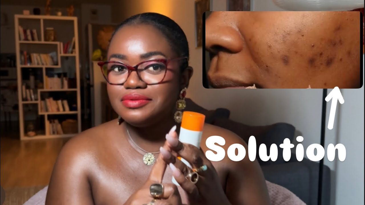 COMMENT TRAITER LES&nbsp;TACHES ET&nbsp;HYPERPIGMENTATION