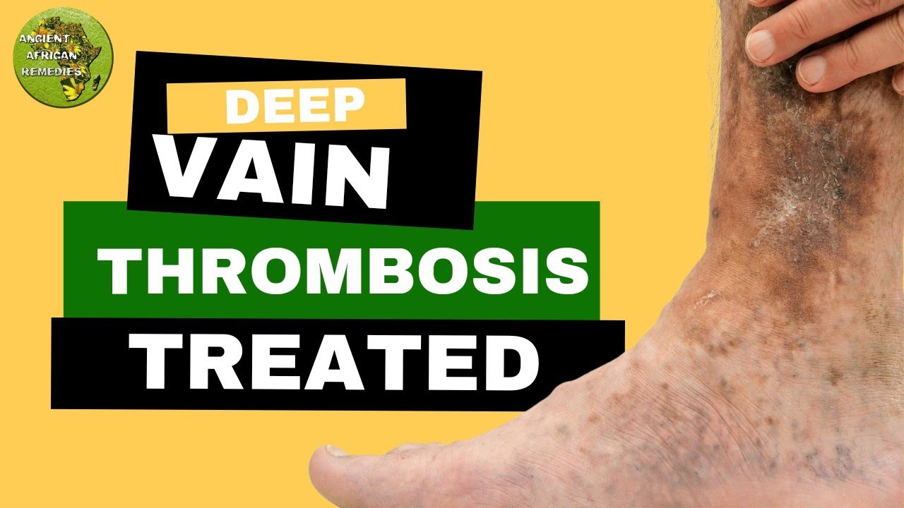 Success story of Deep Vein Thrombosis Treated with Ancient African Remedies Product