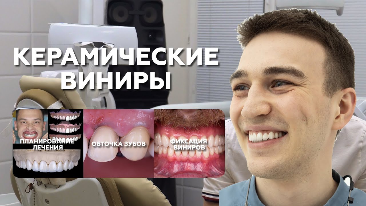 Керамические виниры: обточка, фиксация, планирование