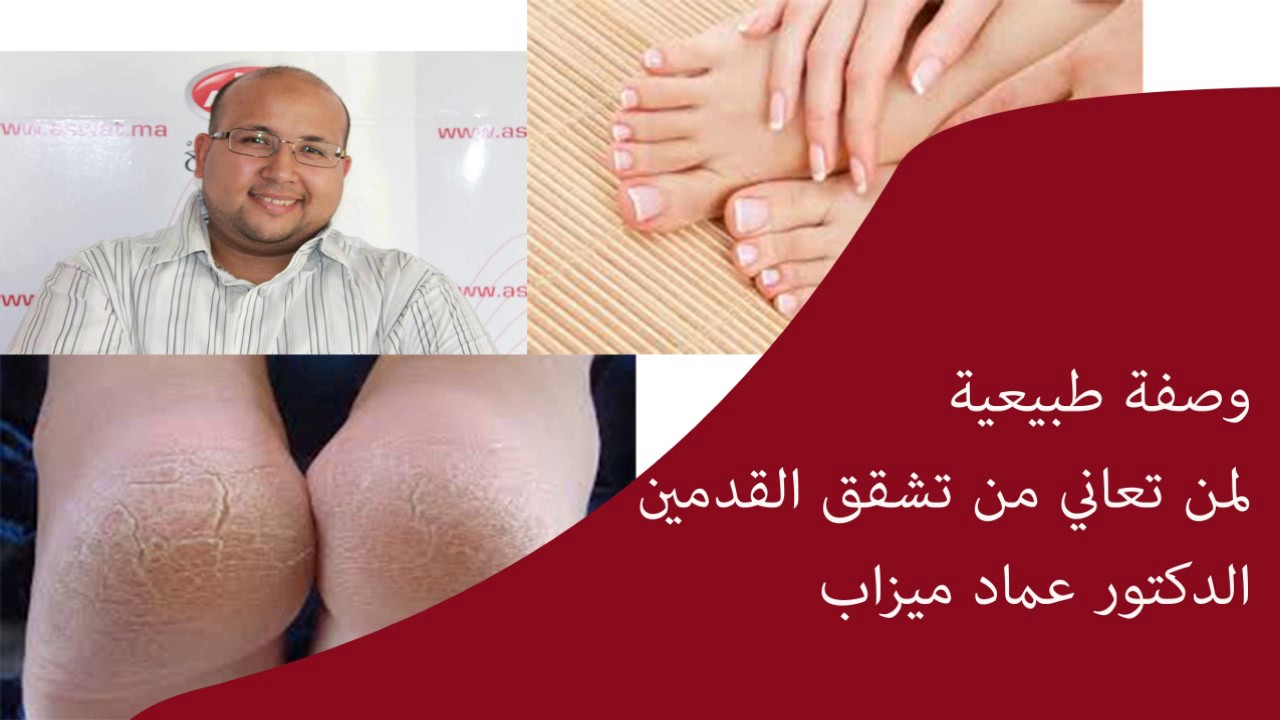 وصفة طبيعية لمن تعاني من تشقق القدمين الدكتور عماد ميزاب