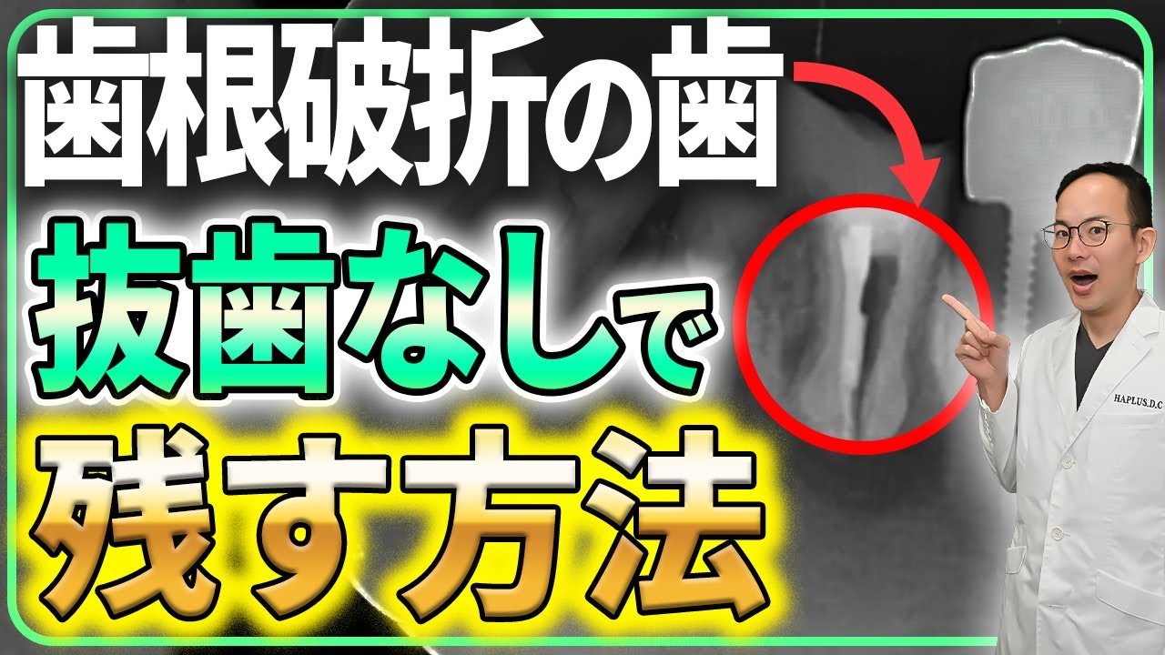 歯を失う原因第１位の歯根破折になった際にその歯を残す治療法とは？歯医者が歯根破折について予防法や歯を残す治し方など徹底解説させていただきます