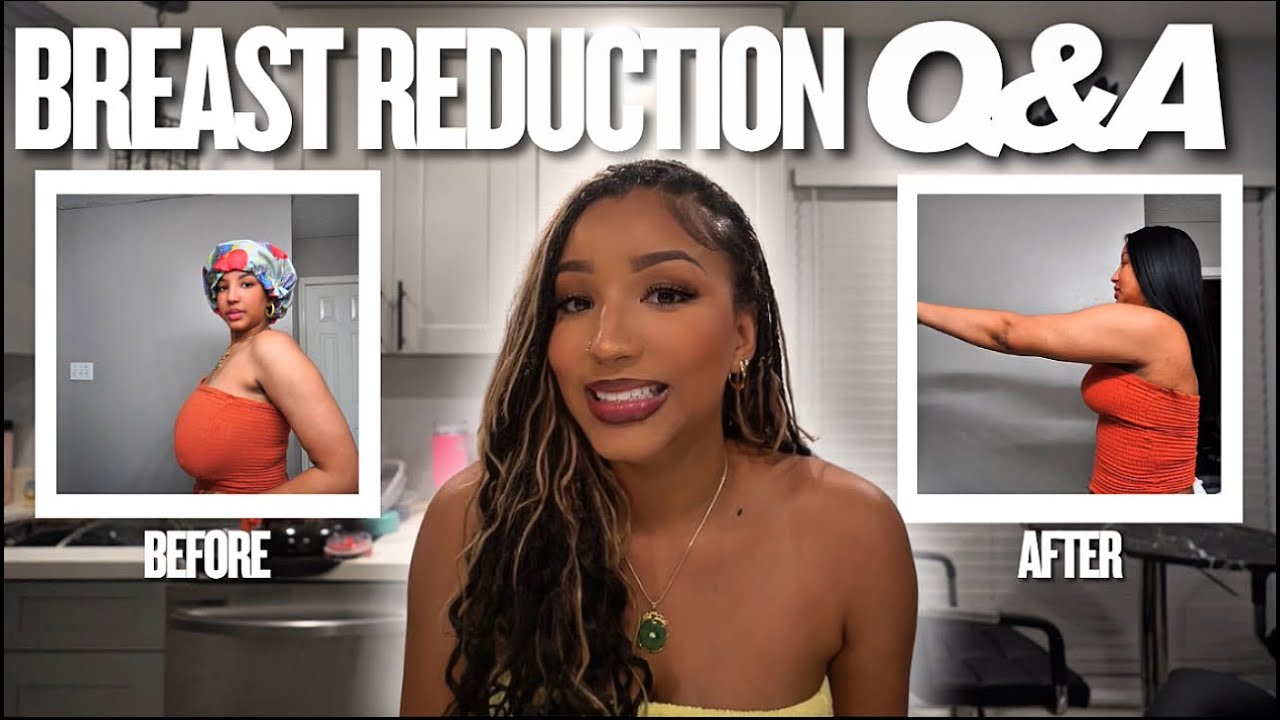 Breast Reduction Q&A | Surgery, Recovery, Insurance & What I Wish I Knew