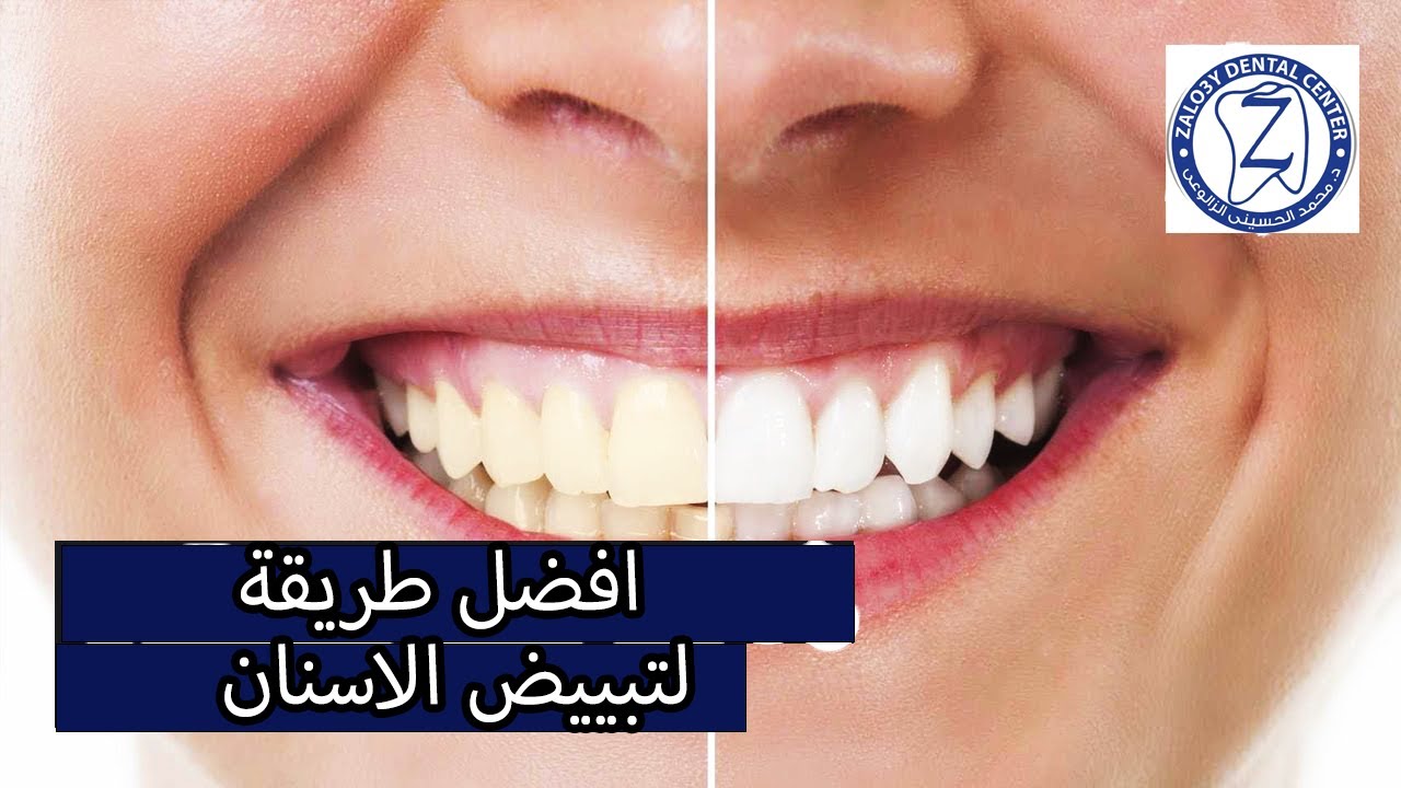 افضل طريقة لتبييض الاسنان