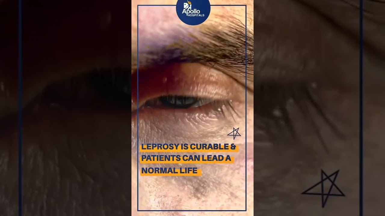 Exposing the Myths around Leprosy | Apollo Hospitals