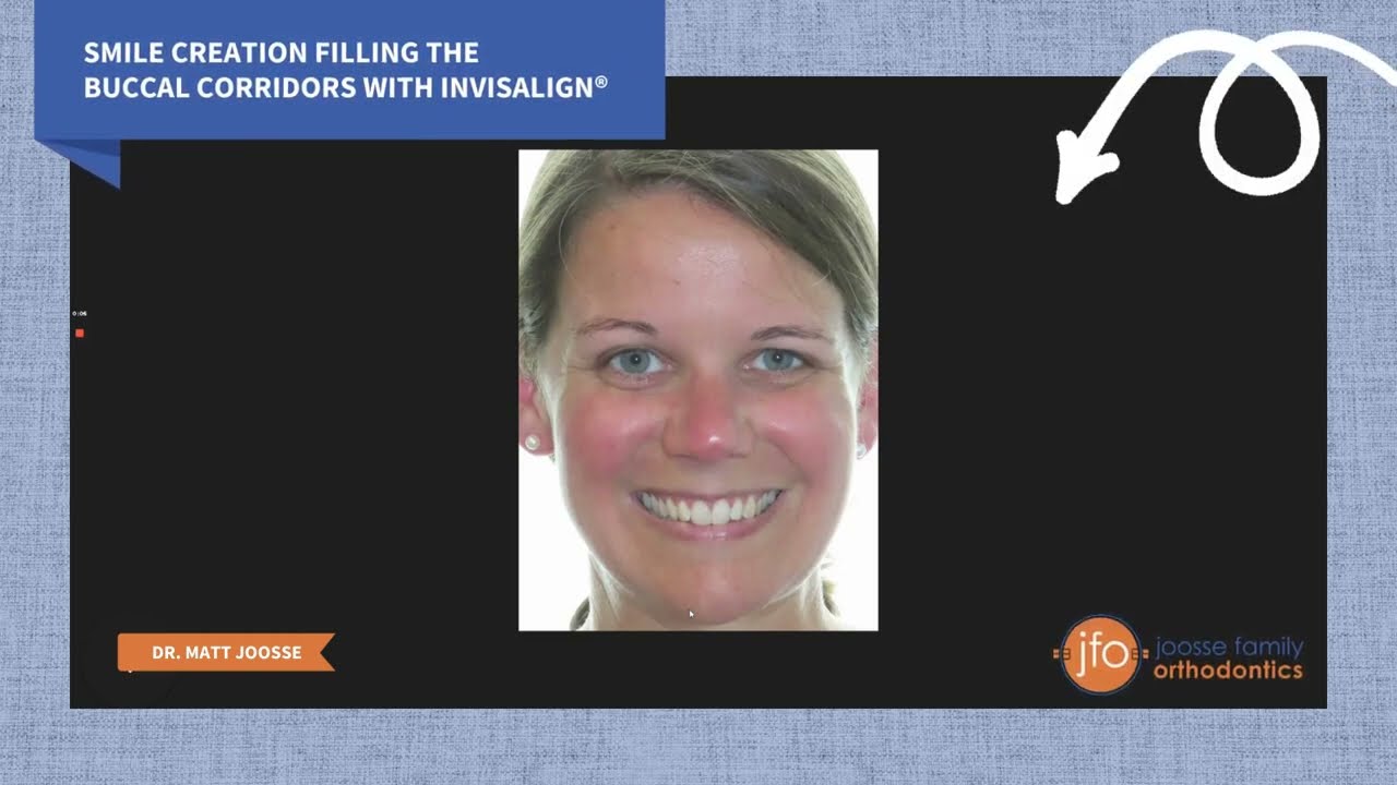 Filling Buccal Corridors & Creating Beautiful Smiles with Invisalign® | Joosse Family Orthodontics