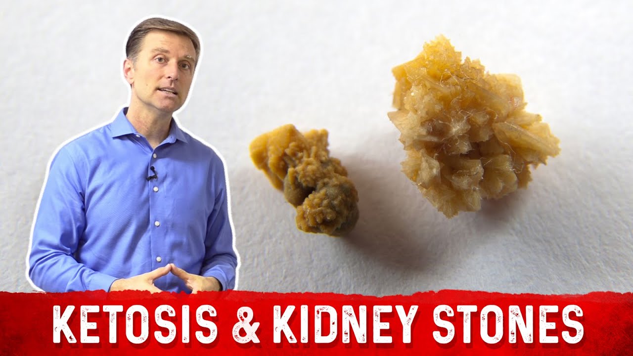 Ketosis and Kidney Stone Prevention &ndash; Dr. Berg